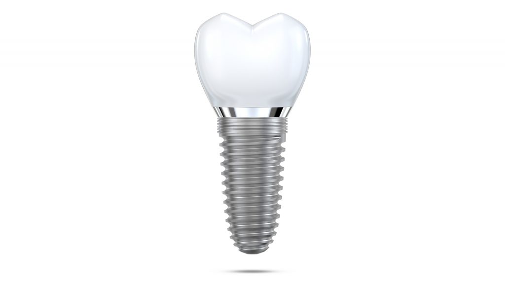 Dental implant model of molar tooth as a concept of implantation teeth and dental surgery. 3d rendering illustration isolated on white background.