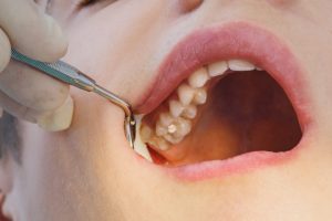 Dental treatment in the dental clinic. Rotten carious tooth close up macro. Treatment of endodontic canals