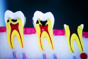 Dental tooth model showing teeth decay, gums and root canal.