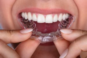 Close-up Of A Woman's Hand Putting Transparent Aligner In Teeth