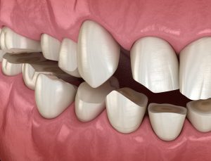 Dental attrition (Bruxism) resulting in loss of tooth tissue.  Medically accurate tooth 3D illustration