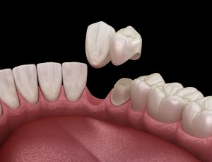 Cantilever bridge made from ceramic, frontal tooth recovery. Medically accurate 3D animation of dental concept